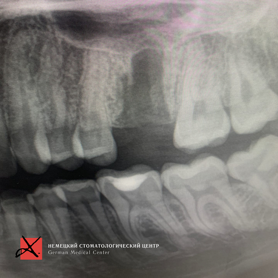 Фото работы Костная пластика с последующей имплантацией 4